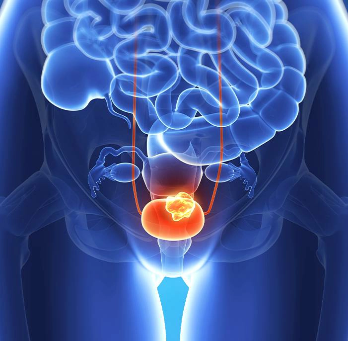 Bladder cancer in a woman, highlighting the bladder