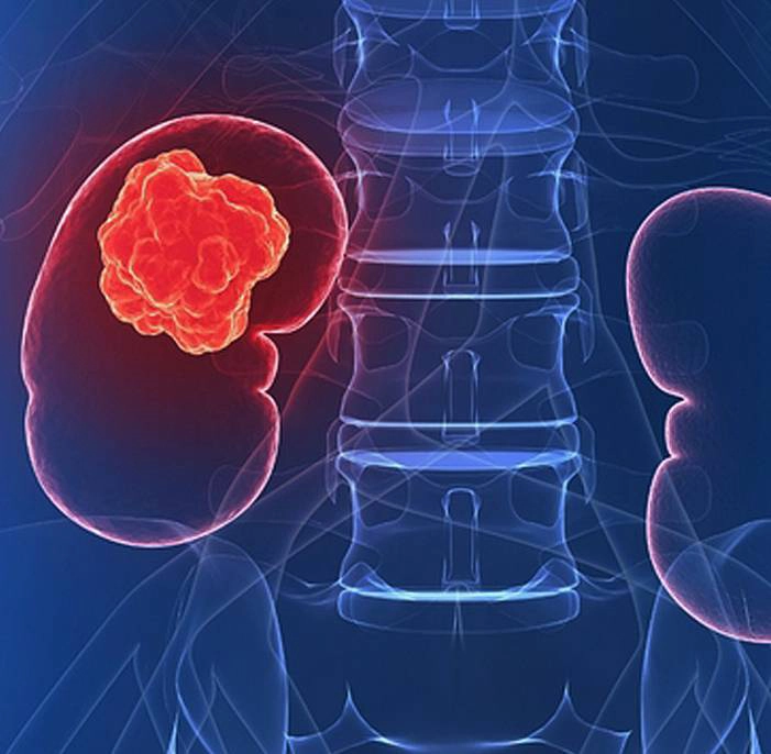 CT scan showing a kidney cancer tumor detected in the kidney