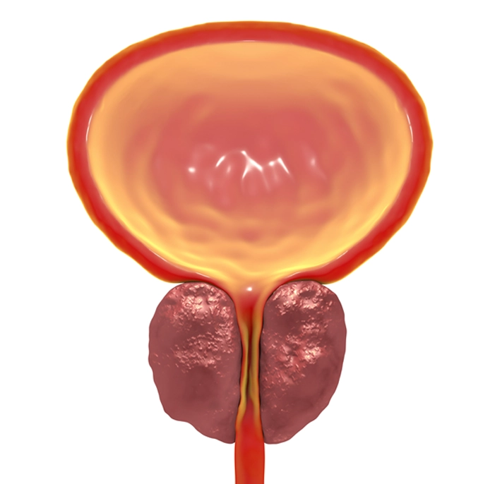 Enlarged prostate causing urethra obstruction