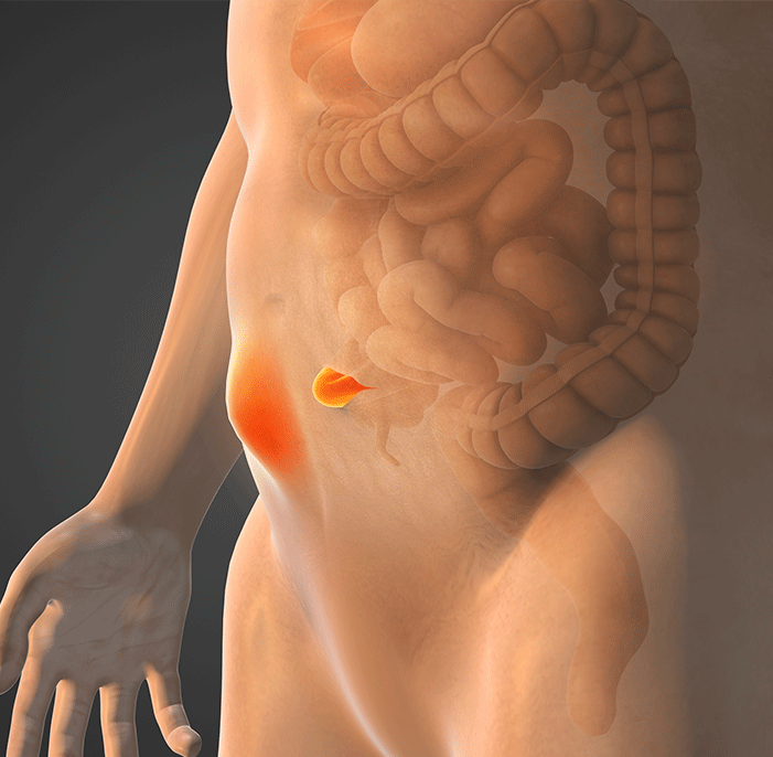 What is a Hernia?