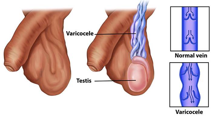 Varicocele  Tan Urology