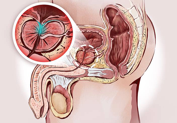Male reproductive system showing prostatitis caused by bacterial infection